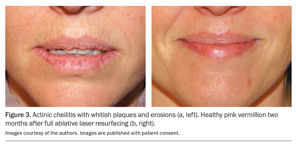 Laser Skin Resurfacing More Than A Cosmetic Procedure Medicine Today